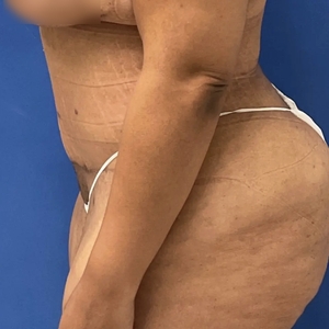 Tummy Tuck #12-after