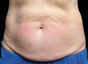 Emsculpt NEO #1-before