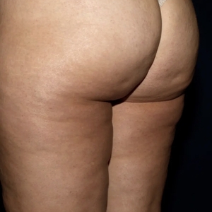 Cellulite Reduction #3-after