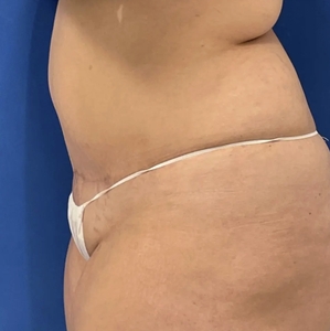 Tummy Tuck #9 (left)-after