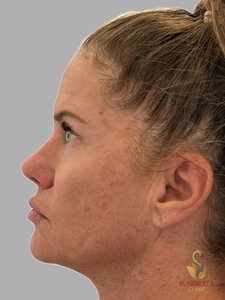 NOUVAglow Mod i week post 1st treatment-after