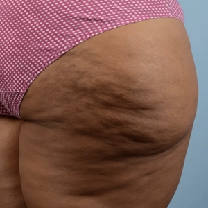 Cellulite Reduction #2-before