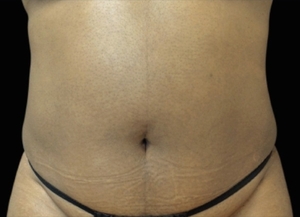 Emsculpt NEO #6-before