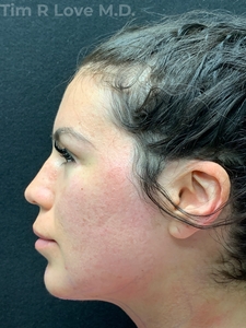 24 hour post op chin implant-after