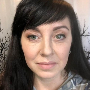 Midface/undereye-after