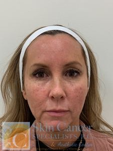 Before and immediately after-before