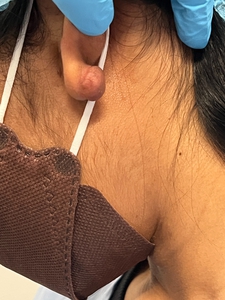 Keloid on ear-after