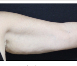 Arm Contouring-after