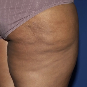 Cellulite Reduction #2-after