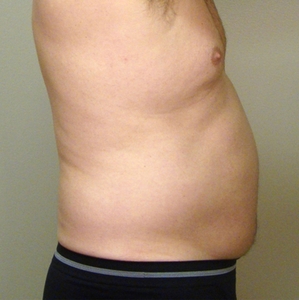 Liposuction #3-before