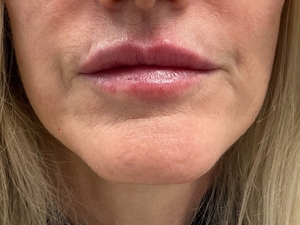 Juvederm b4 & after-before