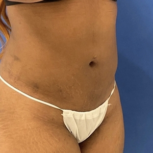 Lipo w Renuvion #10-after