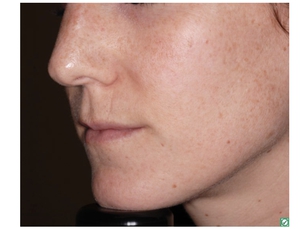 Skin Tone & Texture-before