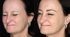 chotox - 20u gl, 10 u fh, 24u CF, 6u lips, 6u mentalis-before