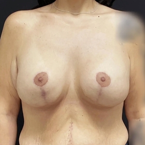Breast Augmentation #23 435 cc-after