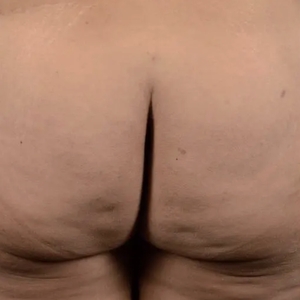Cellulite Reduction #4-before
