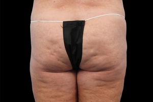 4 Treatments-after