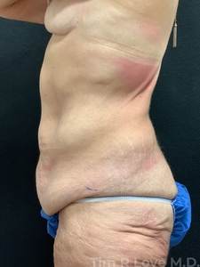 Circumferential Lift-before