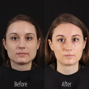 Filler B/A SBA 35-before