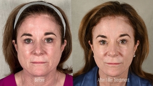 Filler B/A KF-before