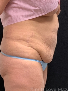 Abdominoplasty - Traditional-before