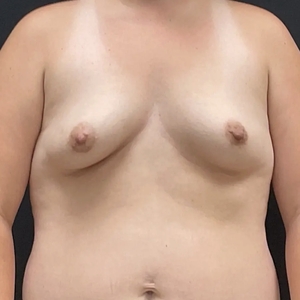 Breast Augmentation #11 650 cc-before