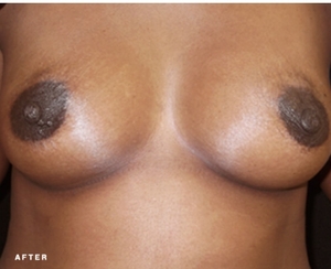 Fat Transfer #2-after