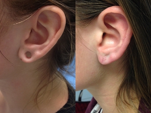 Gauged Earlobe repair-before