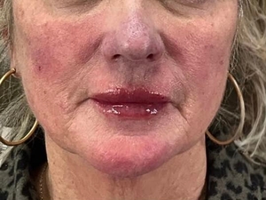 DEKA Pulse Ablation-before