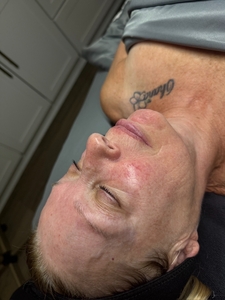 Korean Laser Glow Up Facial and Dermaplaning Add On-before