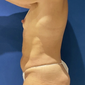 Mommy Makeover #3-before