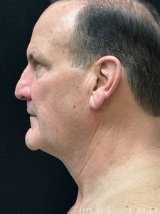 Compare-after