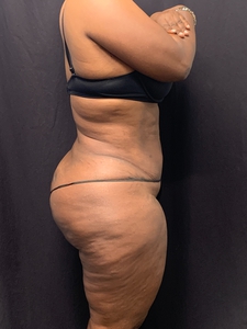 LAL-upper  + Lower abdomen + avelar tuck-after