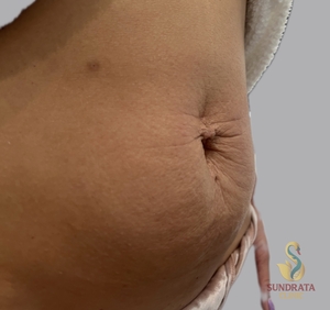 One Xerf Treatment-after