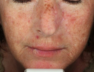 Skin Tone & Texture-before