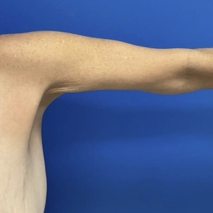 Lipo w Renuvion #4-after