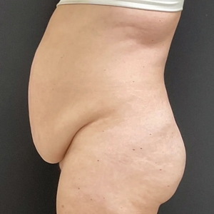 Tummy Tuck #11-before