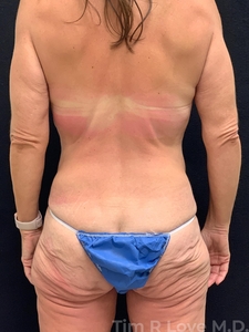 Circumferential Lift-before