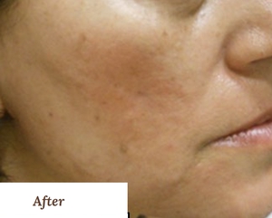 Post Acne Scars & Laxity-after