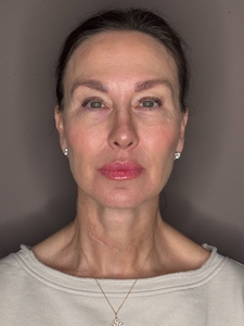 Michelle Sahinler- Hylenex x3-before