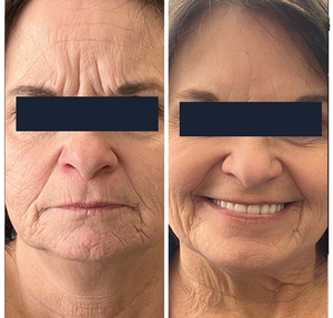 Botox-before
