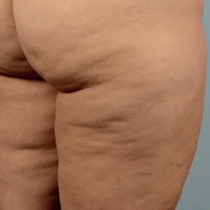 Cellulite Reduction #3-before