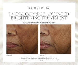 Even & Correct Advanced Brightening Treatment-before