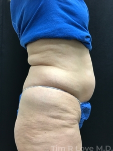 Abdominoplasty - Traditional-before