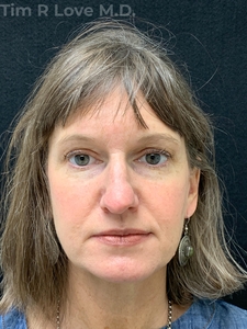 Rhinoplasty - Traditional-before