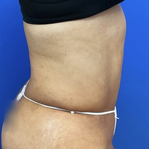 Tummy Tuck #2-after