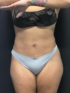 Lipo 360-before