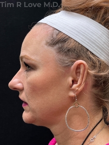 1 month post op traditional rhinoplasty-before