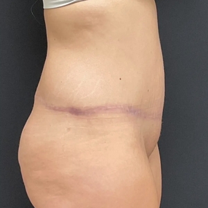 Tummy Tuck #7-after