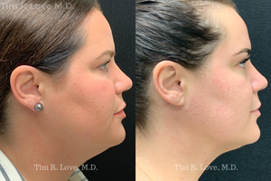 1 month post op MyEllevate, FaceTite, Morpheus8, and Sculptra-before